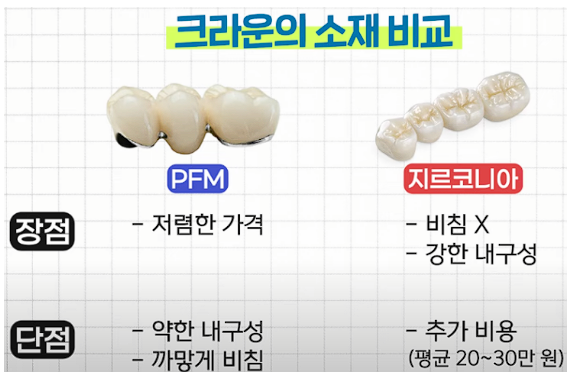 임플란트 종류 가격 뼈이식 비용 구조 국산 외산 크라운 PMF 골드 지르코니아 AS 기간 장점 단....