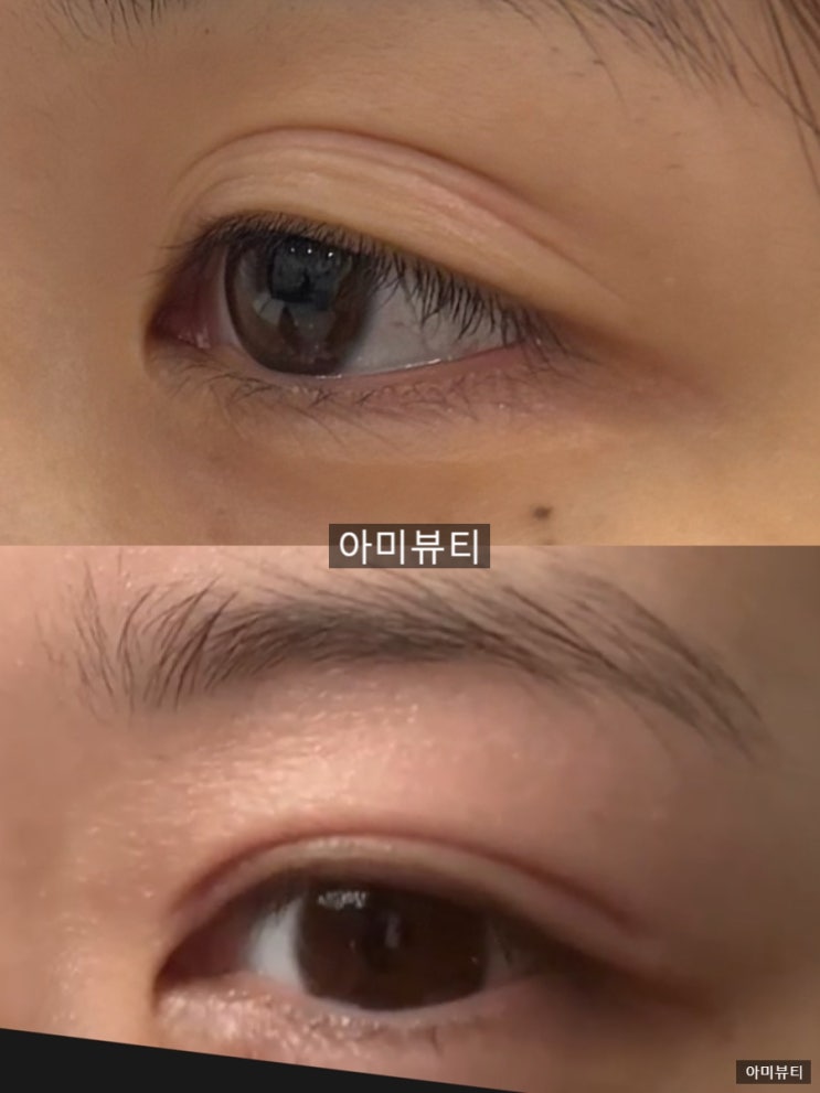  플라즈마 쌍꺼풀 짝눈 눈매교정 | 전국에서 찾아오는 아미뷰티