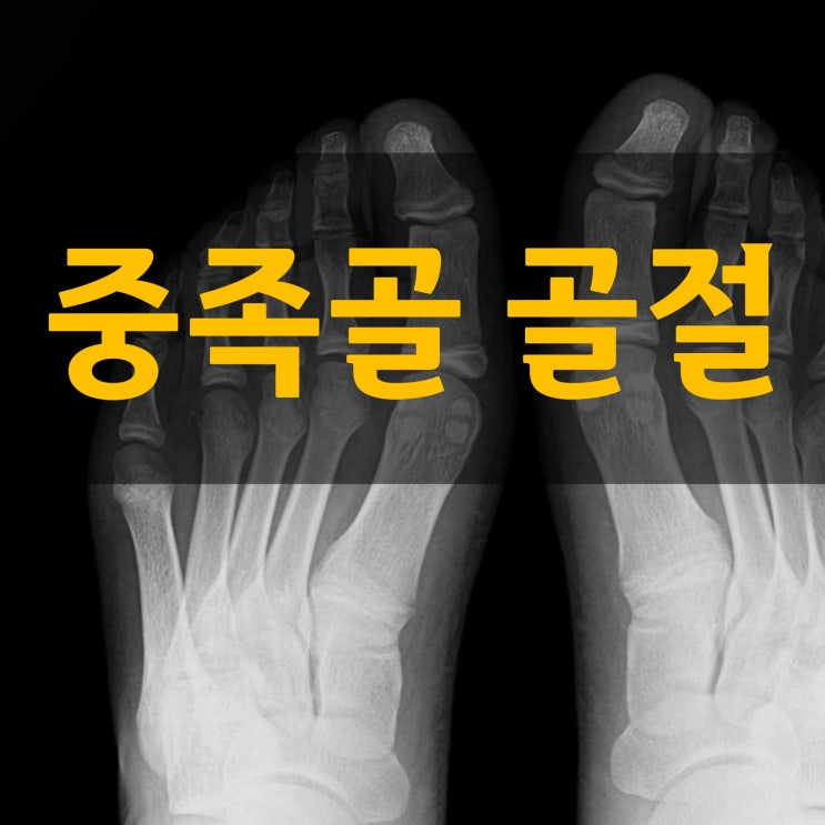  중족골 골절 회복, 골진의 역할과 관련 연구 소개