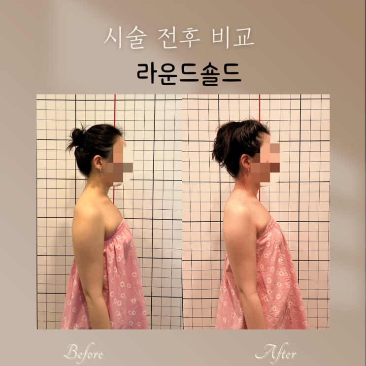  부산 피부관리 라운드숄더 거북목