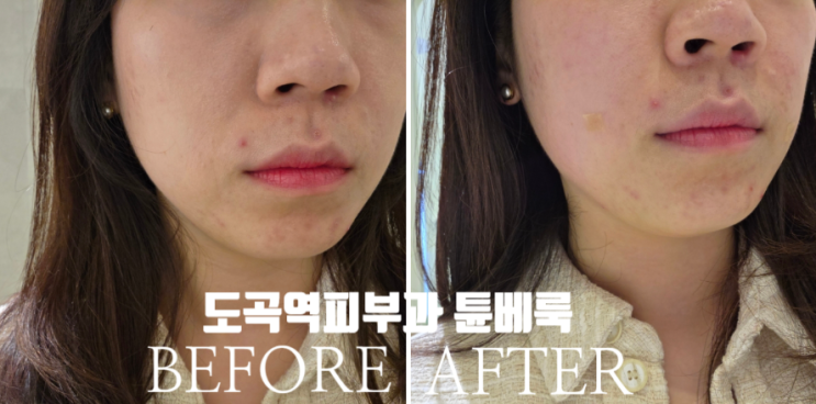 도곡역 피부과 팔자주름 튠페이스 쥬베룩볼륨 팔자주름 해결