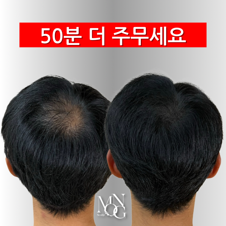  남성 두피문신 반영구 SMP
