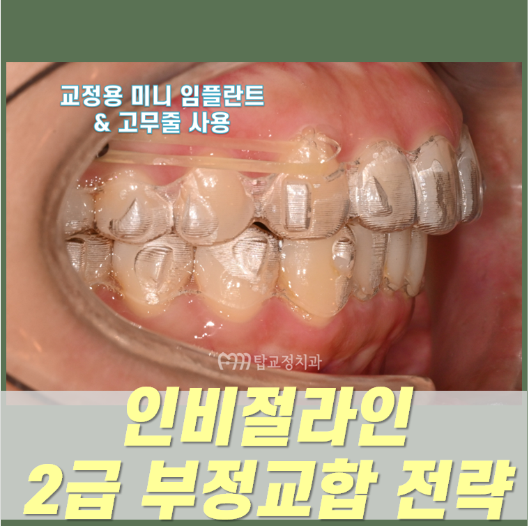 광주 인비절라인 2급 부정교합 치료 방법