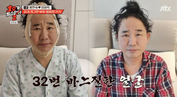 “거의 페이스오프 수준”…최양락, 성형 사실에 개그계 발칵, 쌍꺼풀 수술 2번+안면 거상까....