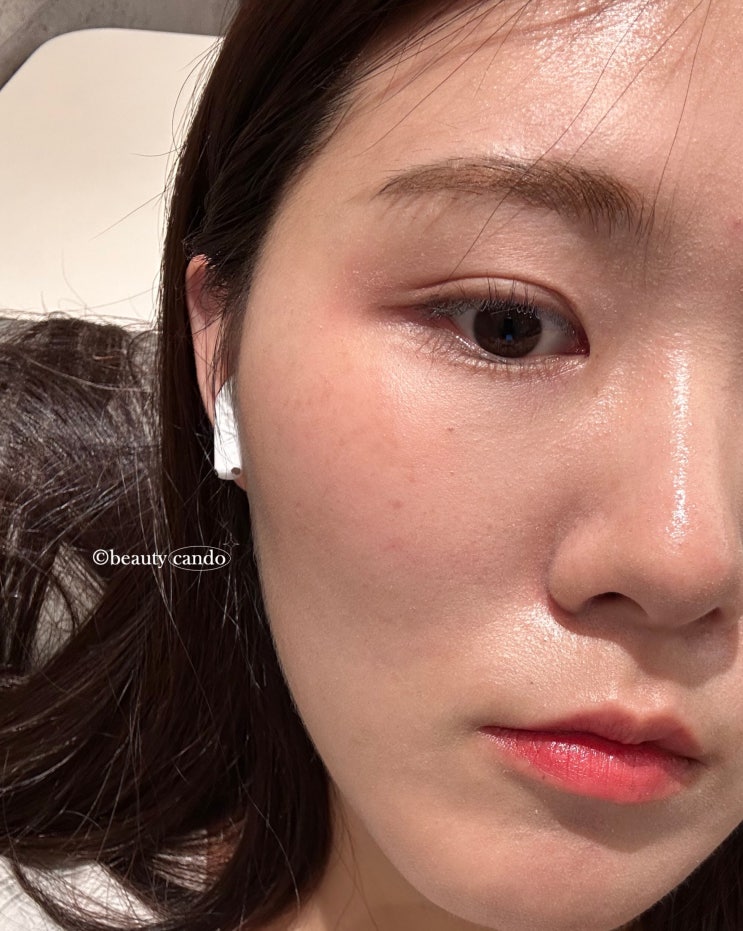  포텐자 통증 및 가격 코모공 축소가능?신사동 피부과 레이저 관리 후기