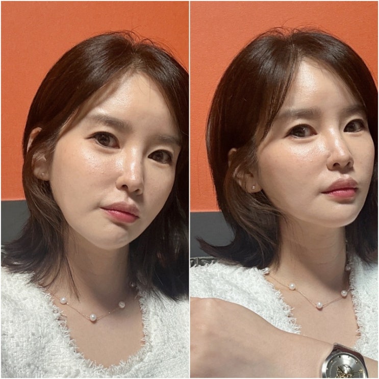 부산브이로리프팅 통증 없는 피부탄력 케어 내돈내산 후기! 부산브이로리프팅 통증 없는 피부탄력 케어 내돈내산 후기!