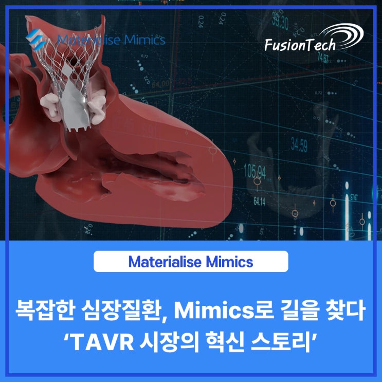  [Materialise S/W] 복잡한 심장질환, Mimics 로 길을 찾다 ‘TAVR 시장의 혁신 스토리’