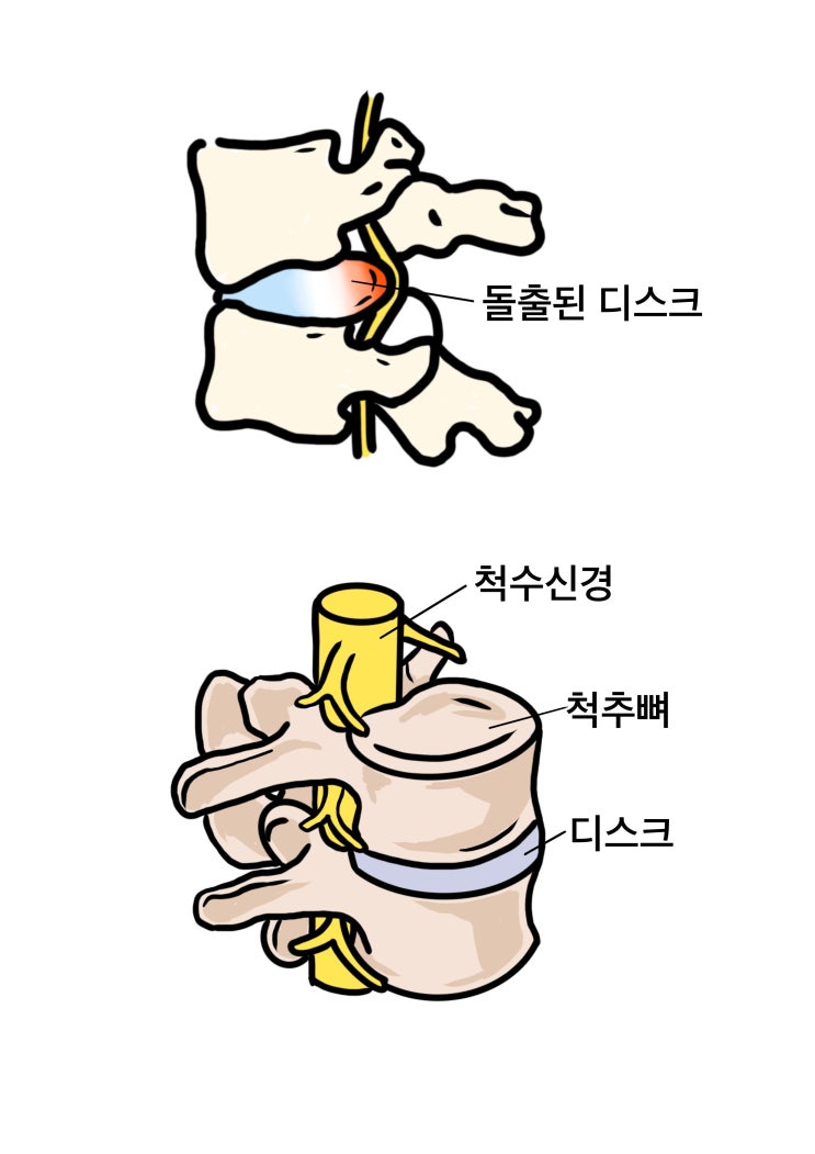  “운동이 정말 허리디스크에 좋을까?”