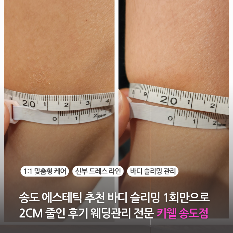  송도피부관리 에스테틱으로 웨딩케어 바디 슬리밍 관리 1회만으로 2cm 줄인 키웰 인천 송도점