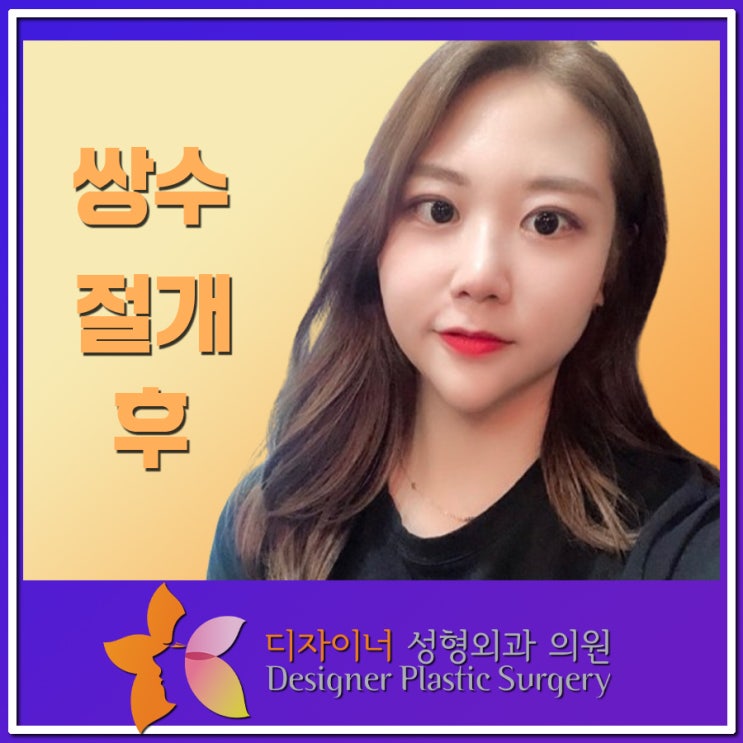  쌍꺼풀 수술비용 어떤 기준으로 결정될까?