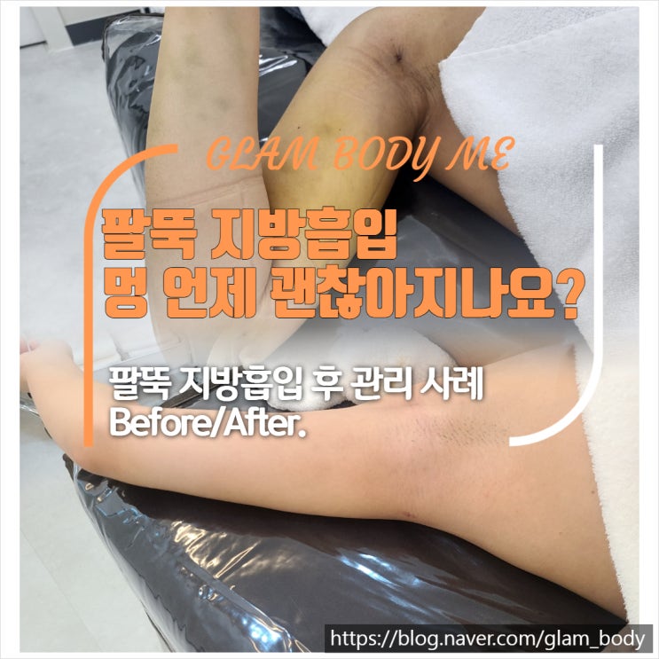  팔뚝 지방흡입 멍 언제 괜찮아지나요? (2주 차 - 5주 차) B&A