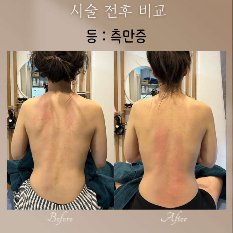 “등 측만증 시술 전후 비교! 척추가 휘는 이유와 방치 시 몸의 변화는?”