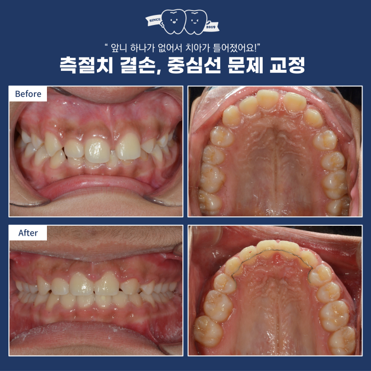  하남교정, 앞니가 결손된 경우 임플란트 없이 교정치료, 잇몸 미소 개선 위한 gingivectomy(잇몸 절제술), 과개교합