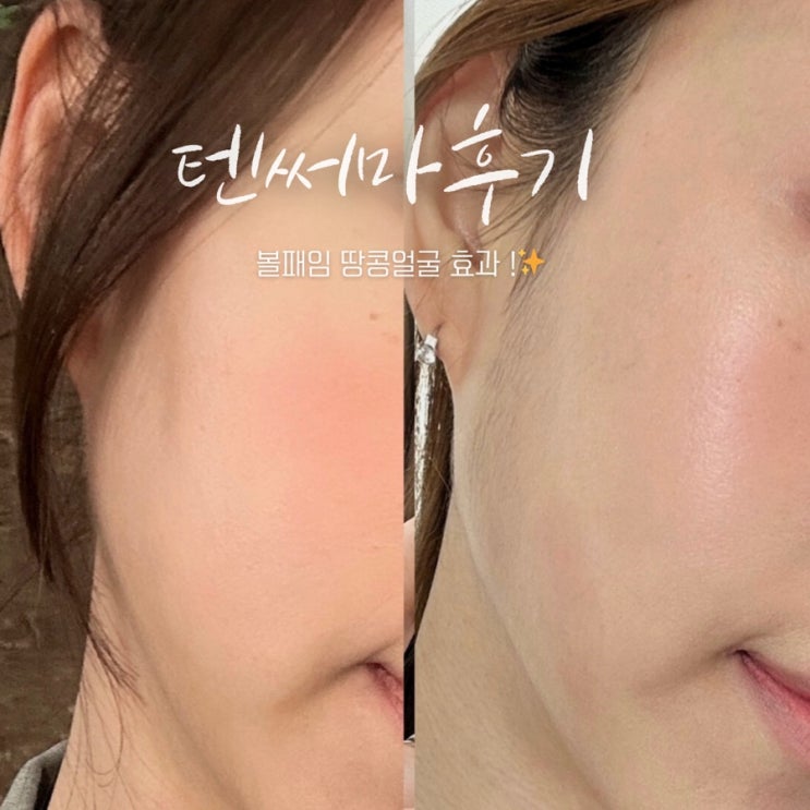  청담피부과 텐써마 300샷 통증 가격 효과 볼패임없는 써마지 저렴이 