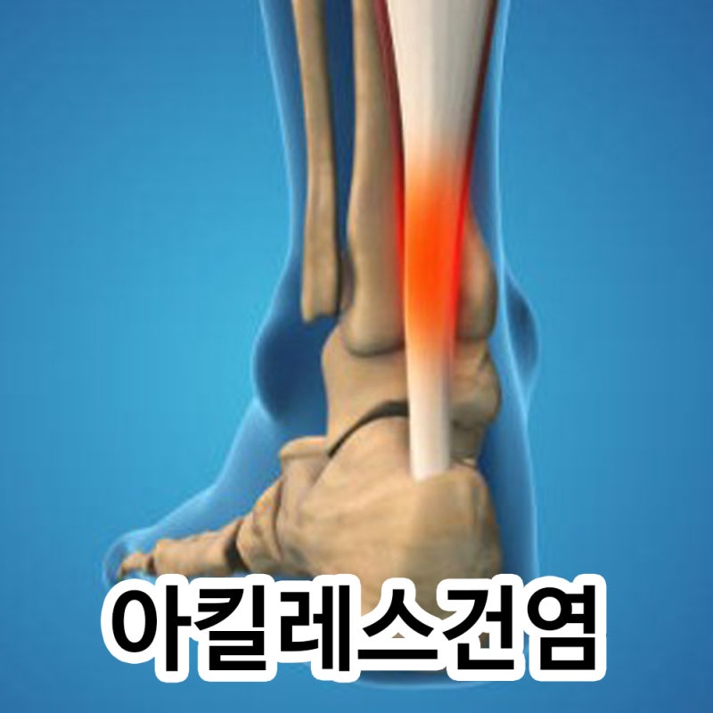 아킬레스건염 통증 증상, 보호대 운동 수술 치료