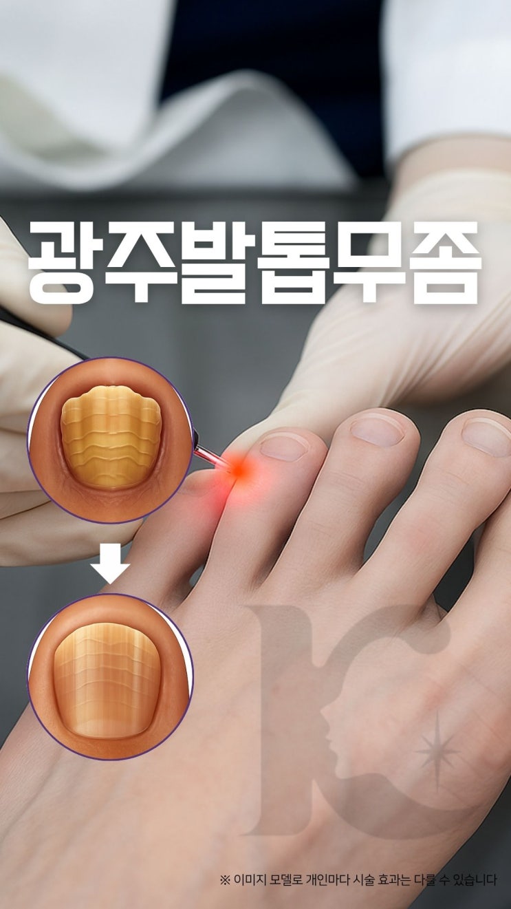  광주발톱무좀 수완지구에서 레이저로 무좀 치료해보고 싶다면