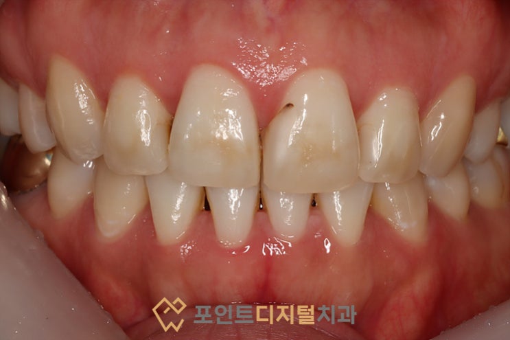  [탕정치과] 타치과 레진 변색 재치료 / 천안 아산