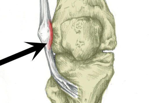  장경인대마찰증후군 오른쪽 왼쪽 무릎통증 원인 장경인대 증후군 증상 치료 알아보자