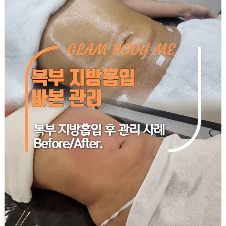  복부 지방흡입 바본, 이렇게 달라질 수 있어요! (2주 차 – 5주 차 B&A)”