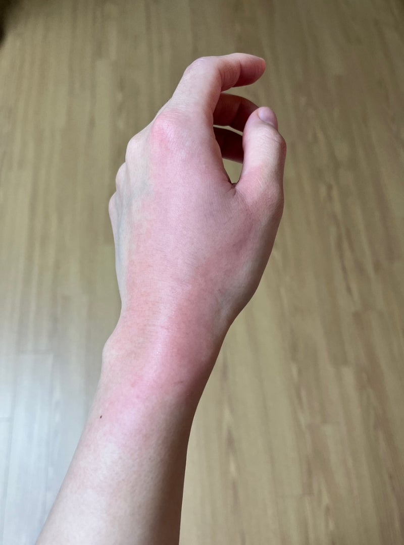 뜨거운 물 화상 입었을 때 광주 화상전문병원 시원외과 치료 후기