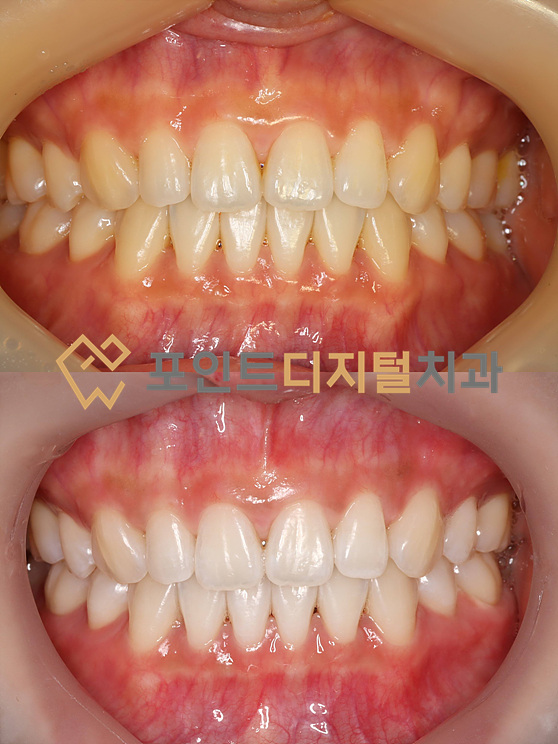  [탕정치과]  오스템 뷰티스 원데이 치아미백 케이스 / 천안 아산 불당 배방