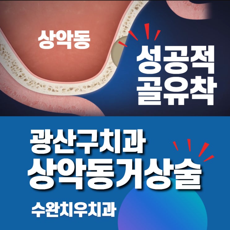  광산구치과 성공적인 골유착을 위한, 상악동거상술