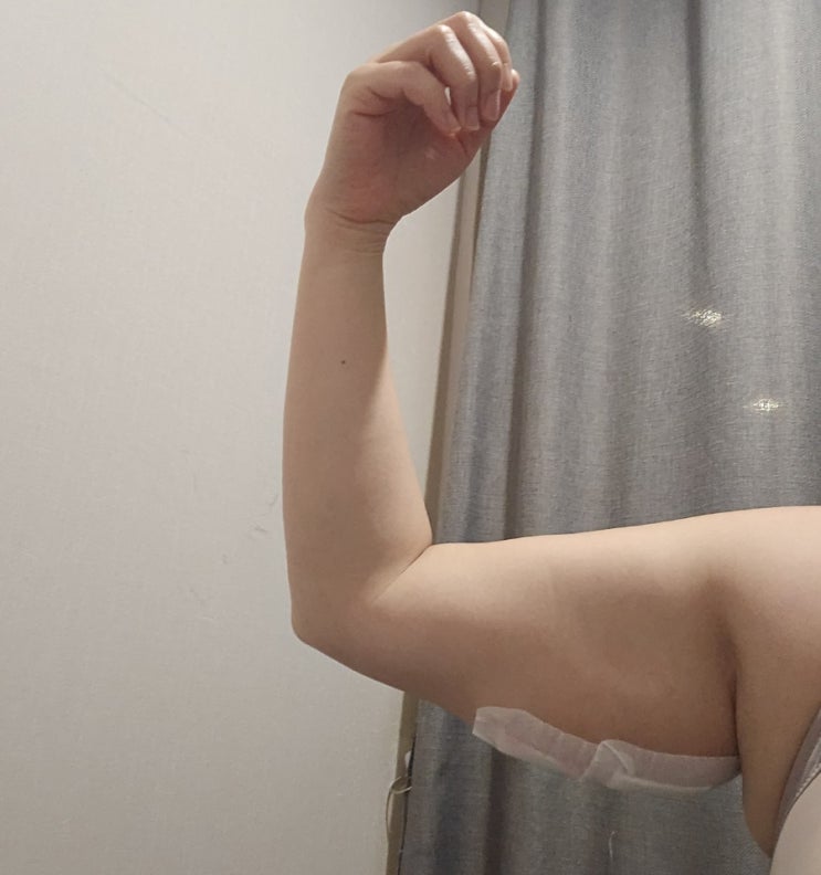  팔뚝 지방분해주사 효과 통증 5회차 후기