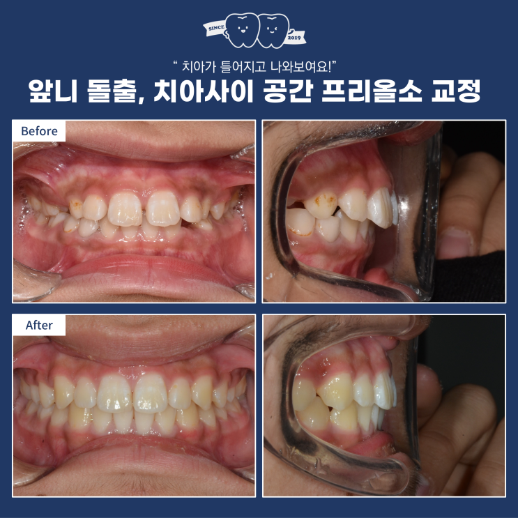  프리올소 1차 예방교정이자 마지막 교정, 어린이 돌출 과개교합 부정교합 치료