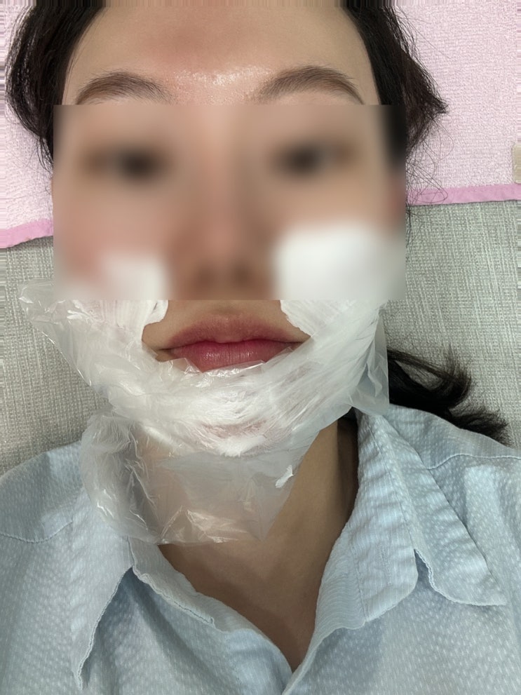  부산피부과추천 팔자주름 쥬베룩볼륨 내돈내산후기