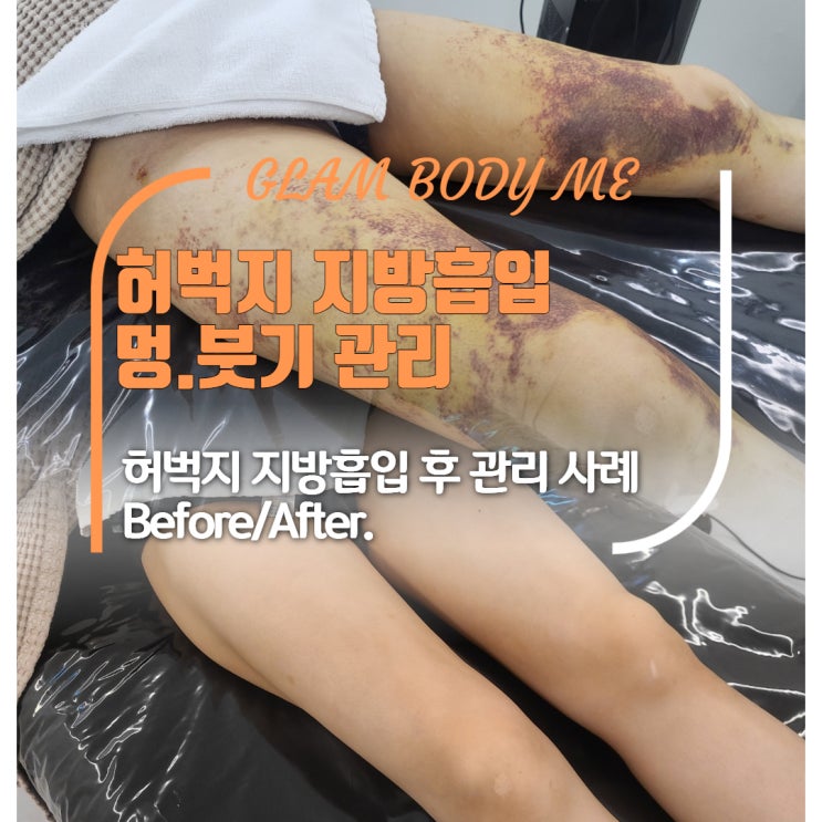  허벅지 지방흡입 멍,붓기 이렇게 오래가도 괜찮을까요? (2주 차 - 5주 차) B&A