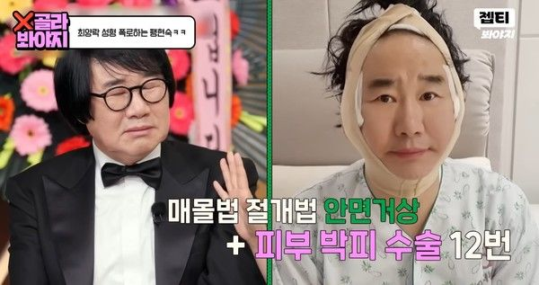 ‘63세’ 최양락, 성형 중독 고백... “쌍꺼풀 2번+안면거상까지”