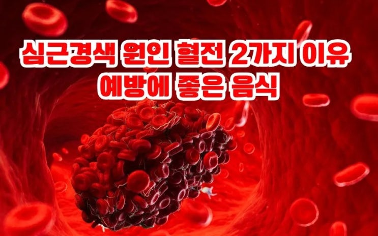  심근경색 원인 혈전 이유 심근경색 예방에 좋은 음식