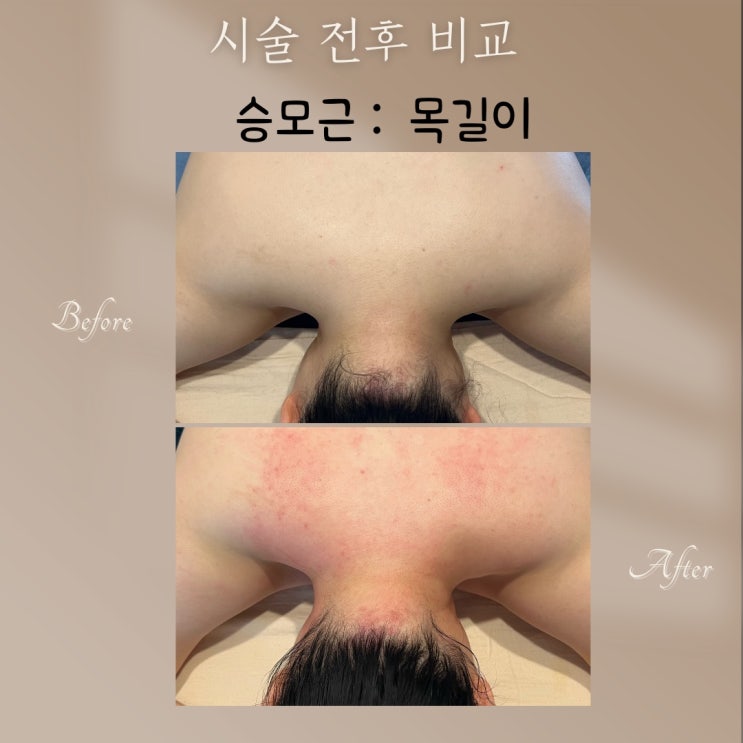  목이 짧아 보이는 이유는 따로 있어요! 부산 명륜동 피부관리실 승모근 관리 Before & After