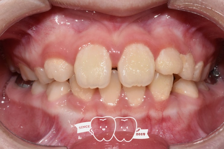 치아 사이가 벌어져도 교정이 필요한가요? –치간이개(Diastema)의 원인과 치료 방향