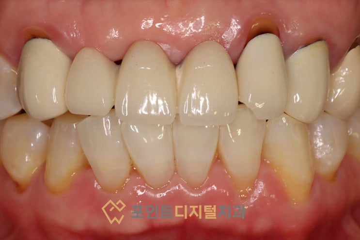  [탕정치과] 오래된 앞니 보철을 새로 하고 싶어요 / 천안 아산