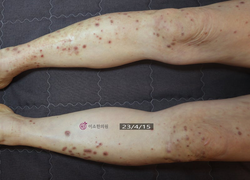 결절성양진, 양진 극심한 가려움 피부 결절, 치료법과 주의사항