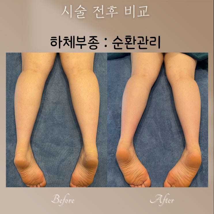  다리 부종, 하루 종일 앉아계셨죠? 부산 비본스킨앤바디 에서 부드럽게 관리해드려요