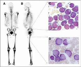 만성 골수성 백혈병(CML) 또는 만성 과립구 백혈병 (Chronic Myelogenous Leukemia)