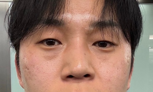 눈밑꺼짐 개선, 울트라콜200 실제 후기 : 강남역피부과 내돈내산 2cc 시술 후 7일 경과 변화 정리