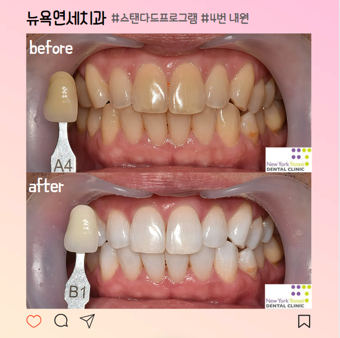  강남역 치과 치아미백 효과 후기, 부작용, 가격