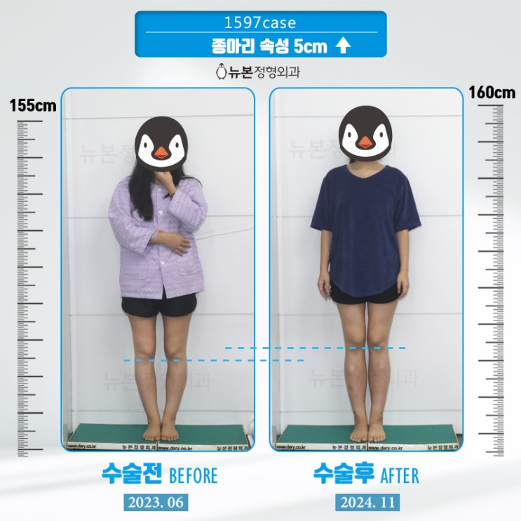 키수술비용 차 한대값 뉴본의 재활 시스템은 간병인 여사님 잔소리도 프로급