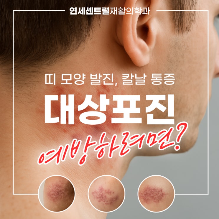  을지로대상포진, 띠 모양 발진과 칼날 통증 예방하려면