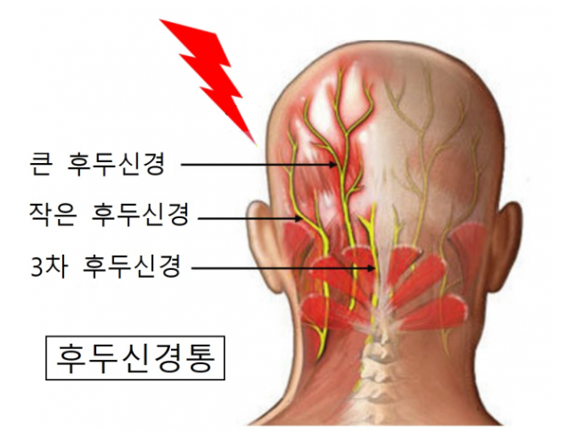 신경외과, 내과/후두신경통