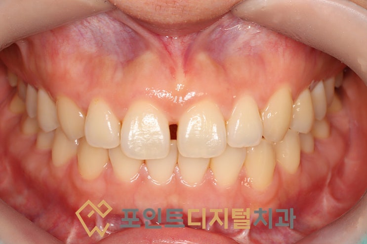  [탕정치과]  앞니 벌어짐 레진 치료 / 천안 아산 불당 배방
