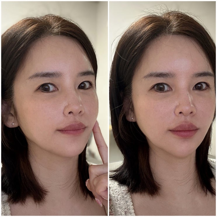 부산 센텀 피부과 잼버실 리프팅 및 팔자주름 없애기 필러 내돈내산 후기 부산 센텀 피부과 잼버실 리프팅 및 팔자주름 없애기 필러 내돈내산 후기