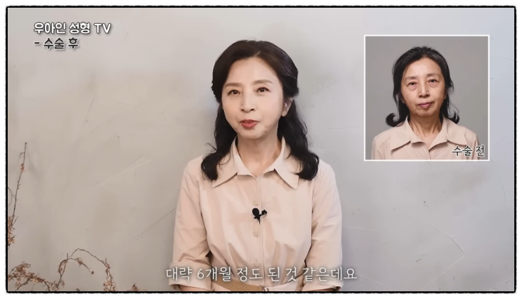  안면거상술 가격, 비용이 다른 이유