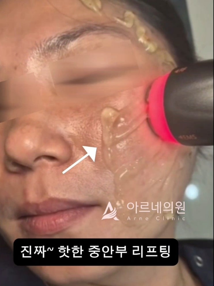  울써마지와 이브타이탄 리프팅 비교 - 통증 효과 유지기간 차이-아르네의원