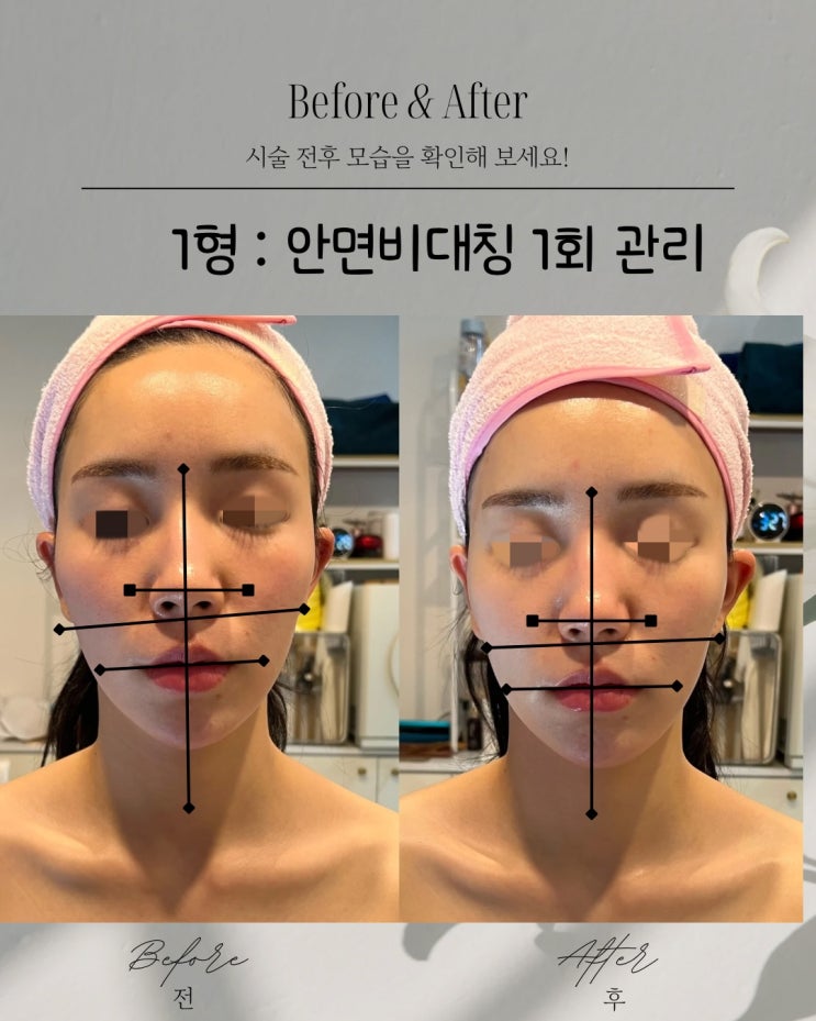  부산피부관리실  얼굴비대칭 비본스킨앤바디 리얼 후기
