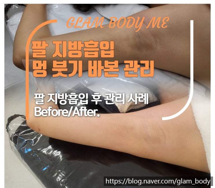  팔 지방흡입 붓기·바본 이렇게까지 오래가도 괜찮을까요?  (2주 차 - 5주 차) B&A