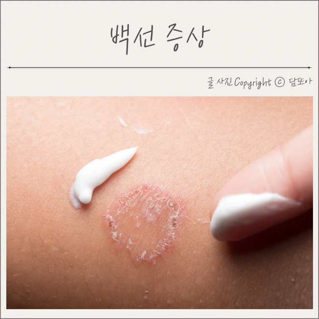  사타구니백선 체부백선 증상 원인 가려움 치료